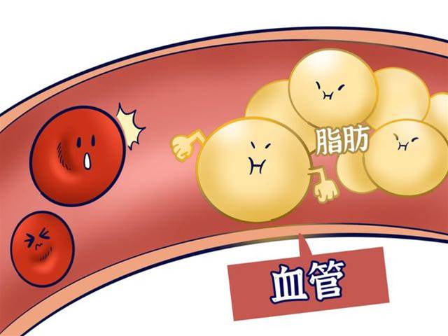 體內甘油三酯水平偏高，記住3個方法，或能在短時間內回歸正常