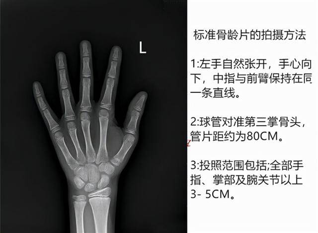 4個骨齡小知識，告訴你關于長高的那些事