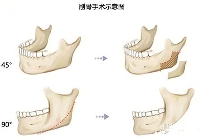 那些“一刀切”削臉的明星還好嗎？有的已垮掉，小方臉成最后贏家