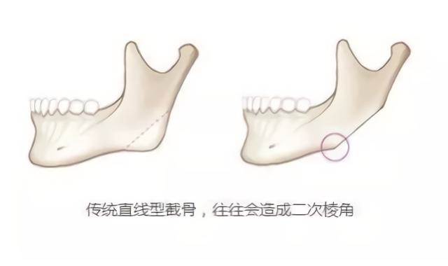 那些“一刀切”削臉的明星還好嗎？有的已垮掉，小方臉成最后贏家