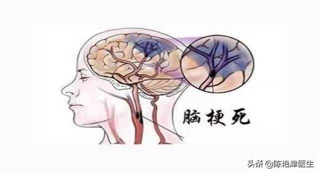 為什么中國腦梗越來越多？醫生：除了補充葉酸，做好這3點更重要