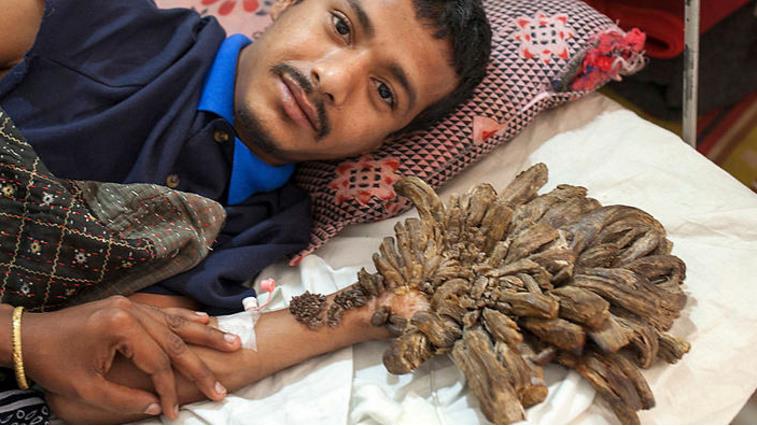 这位来自孟加拉的男子被称为「树人」,他的手和脚长得
