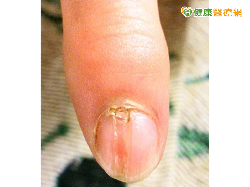 指甲凹陷变形 竟是甲床下球状瘤惹祸